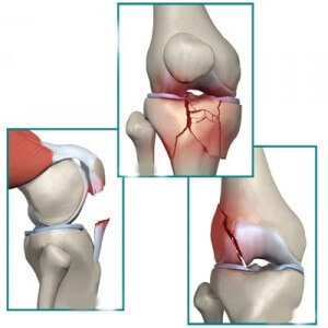 перелом колена 