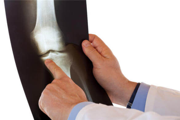 рентген колена