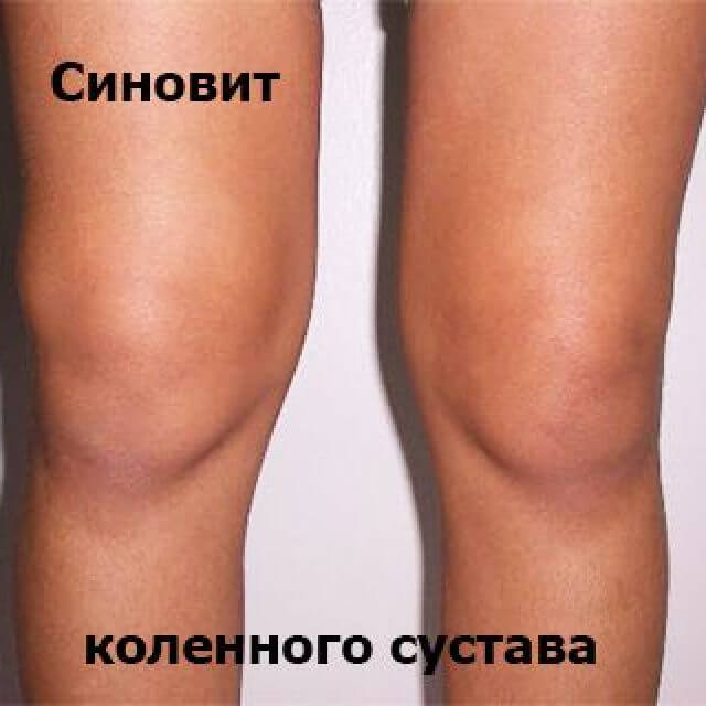 У меня в коленном суставе синовит как лечить У меня в коленном суставе синовит как лечить