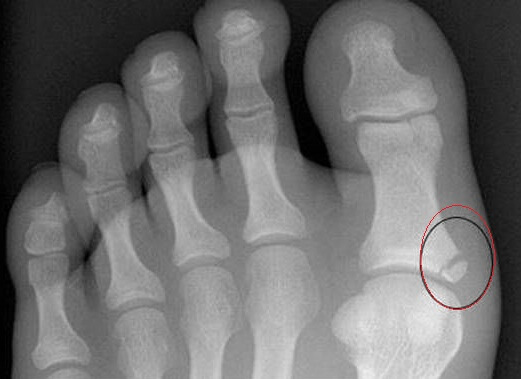 осколок при переломе пальца ноги