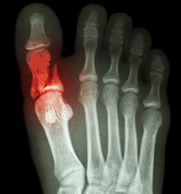 перелом пальца ноги