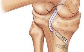 повреждения связок коленного сустава — хирургические способы лечения