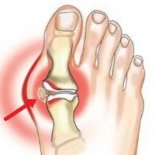 Симптомы и лечение артрита пальцев ног