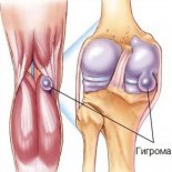 Признаки и лечение гигромы коленного сустава