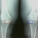 Причины и лечение остеосклероза коленного сустава