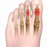 3 правила лечения переломов пальцев на ногах
