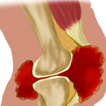 Основные виды и формы синовита коленного сустава